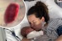 New mum contracts deadly flesh-eating disease a week after childbirth