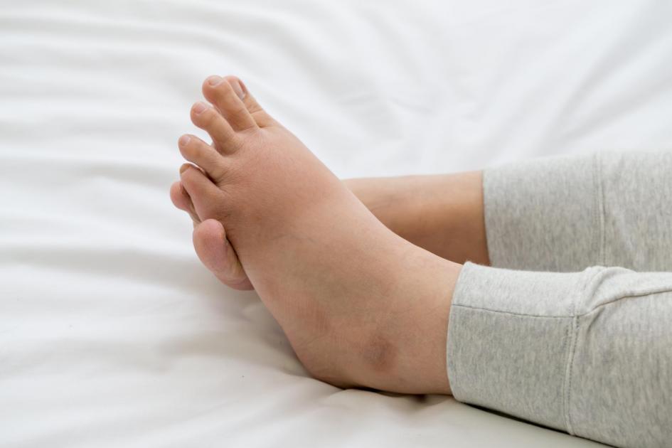 How to prevent swollen feet and ankles in the heat